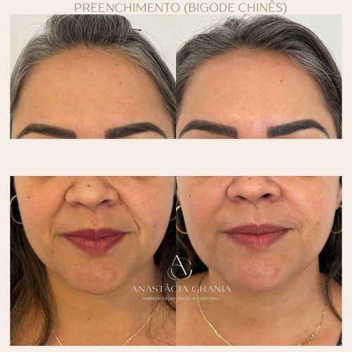 Resultado Harmonização Facial - Antes e Depois