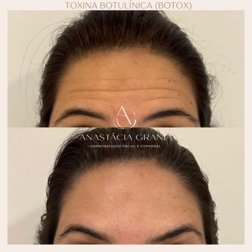 Resultado Preenchimento Labial