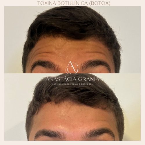 Resultado Preenchimento Facial