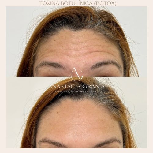 Harmonização Facial - Resultado Natural