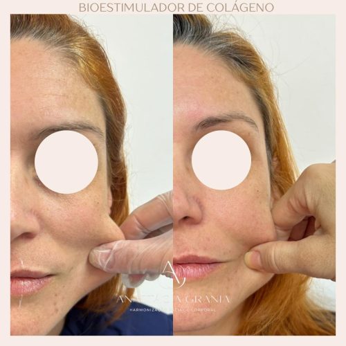 Preenchimento Labial - Resultado