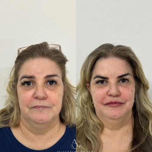 Harmonização Facial - Resultado